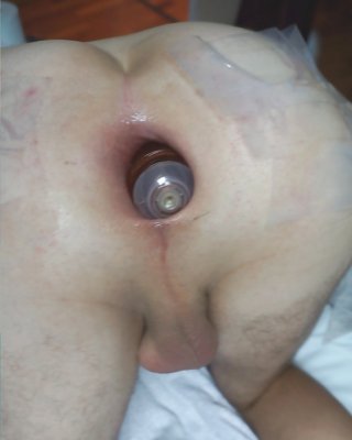 Anal Gaping Wide Open Asshole August 2015