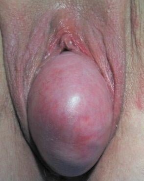無修正　子宮脱 