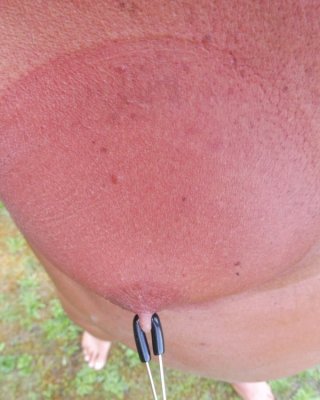 Mes tetons apres pompe a seins et pinces
 #79792696