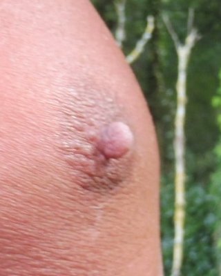 Mes tetons apres pompe a seins et pinces
 #79792703